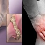 asam urat di kaki