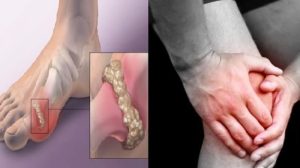asam urat di kaki