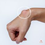 obat ganglion di apotik