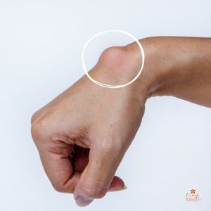obat ganglion di apotik